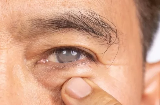 RUYADA GÖZE  PERDE  İNMEK GÖRMEK