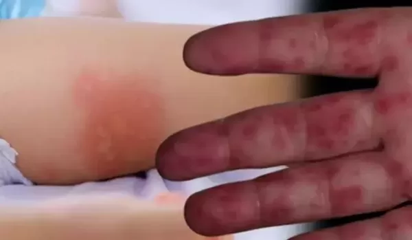 RUYADA  KABARCIK GÖRMEK