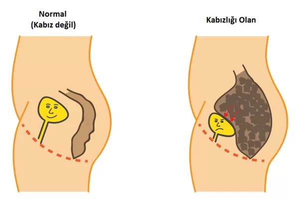 RUYADA  KABIZ GÖRMEK