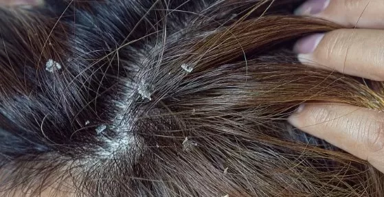 RUYADA  KEPEK GÖRMEK