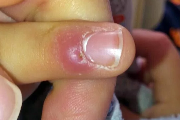 RUYADA    PARMAK   ÇIBANI GÖRMEK