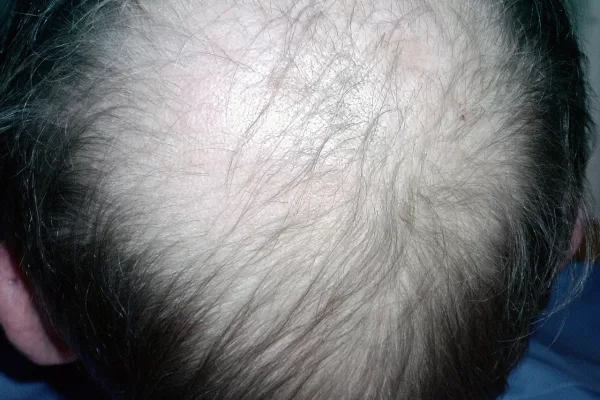 RUYADA  SAÇ DÖKÜLMESİ GÖRMEK