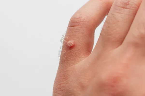 RUYADA   SIĞIL GÖRMEK