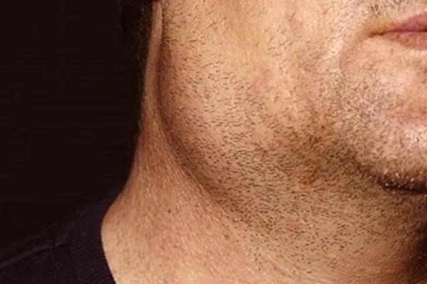 RUYADA    ŞİŞ   VE   VEREM GÖRMEK