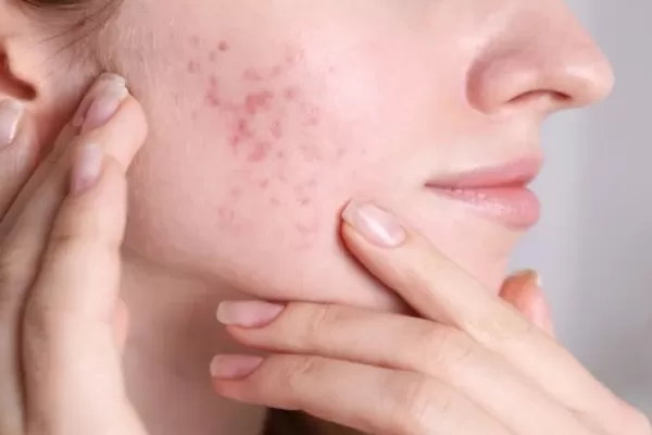 RUYADA  SİVİLCE GÖRMEK