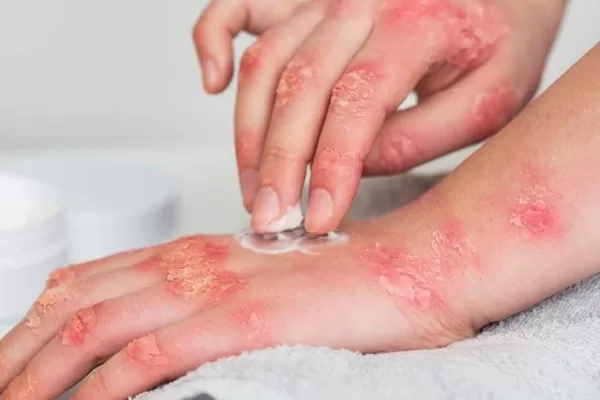 RUYADA   UYUZ GÖRMEK