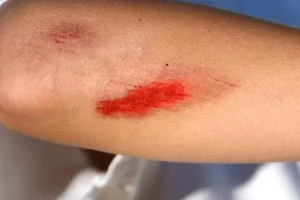 RUYADA   YARA GÖRMEK