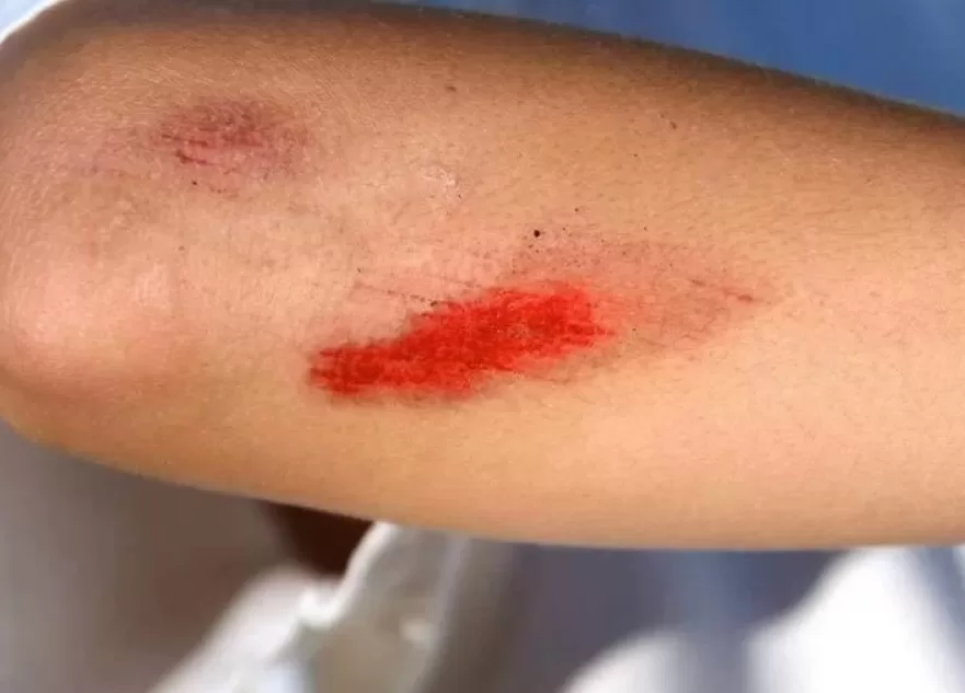 RUYADA   YARA GÖRMEK