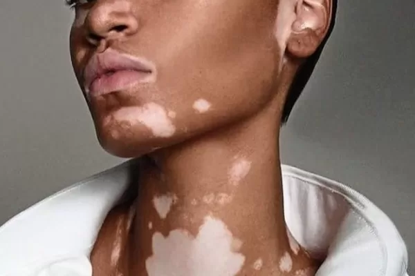 RÜYADA ALACA  İLLETİ GÖRMEK