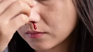 RUYADA  BURUN KANI GÖRMEK